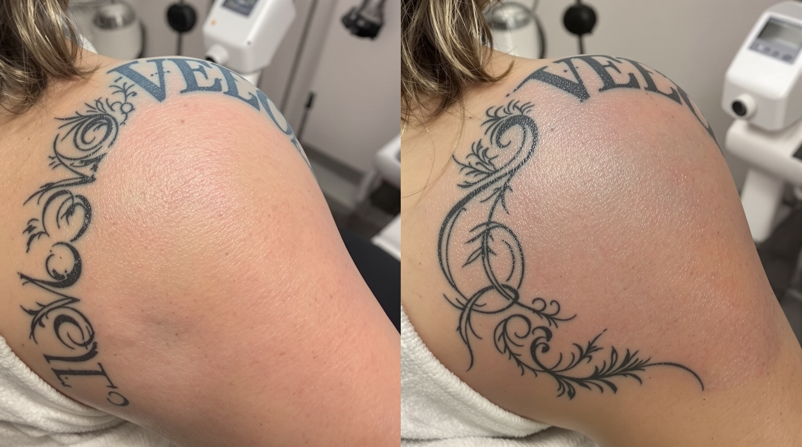 Détatouage laser
